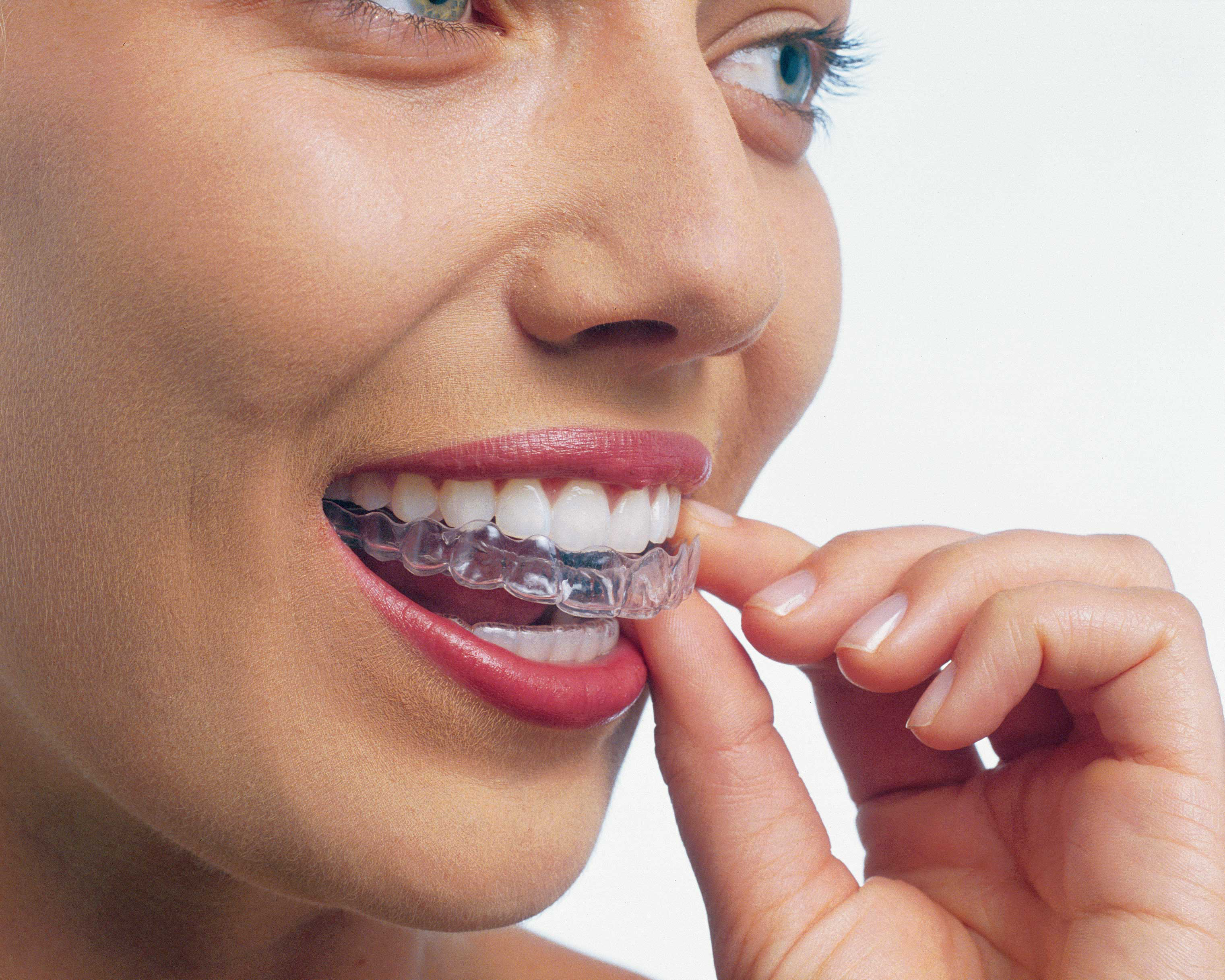 lady wearing invisible braces